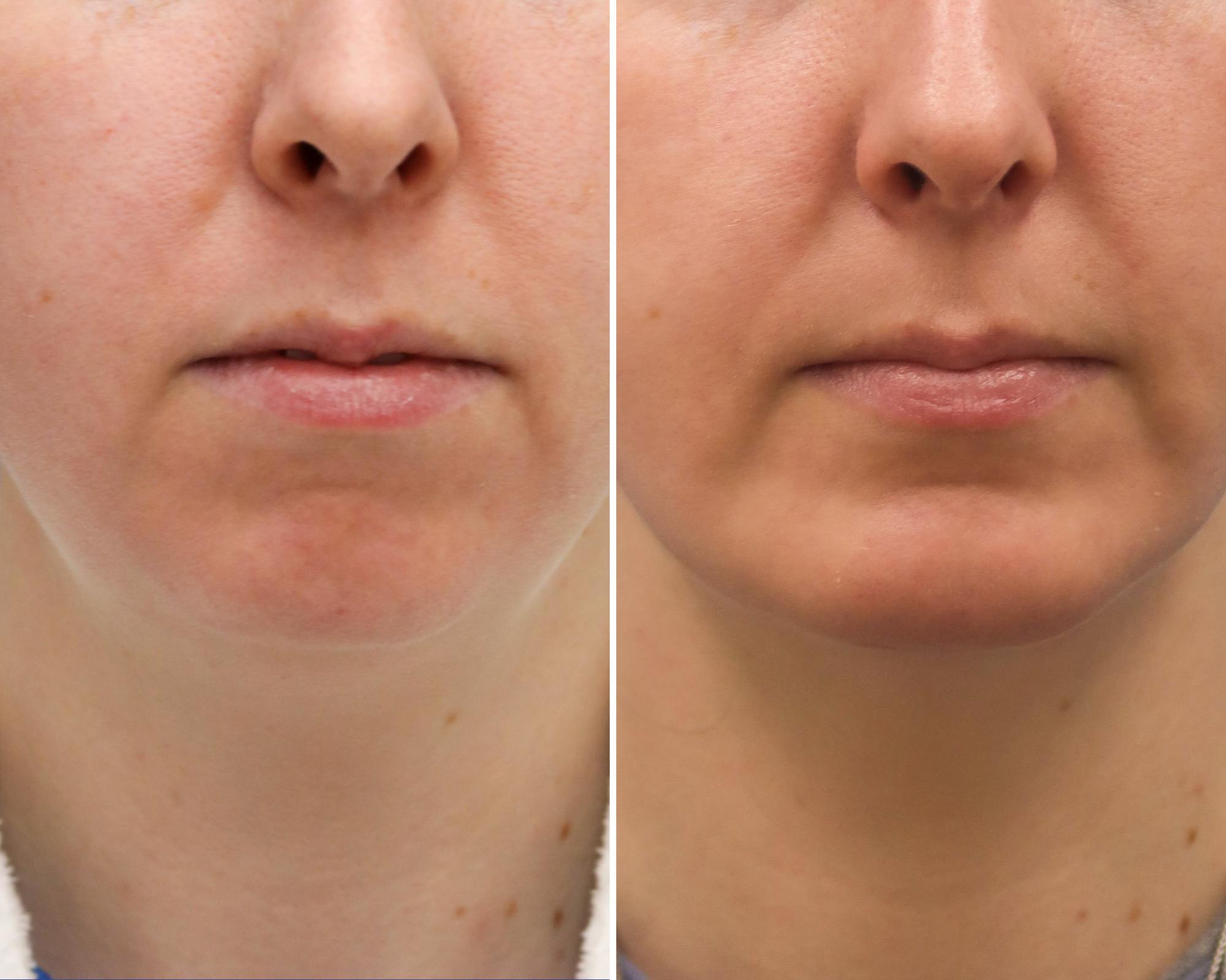 Submental Liposuction Before & After Gallery - Patient 474051 - Image 3