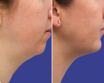 Neck Before & After Gallery - Patient 216636 - Image 1