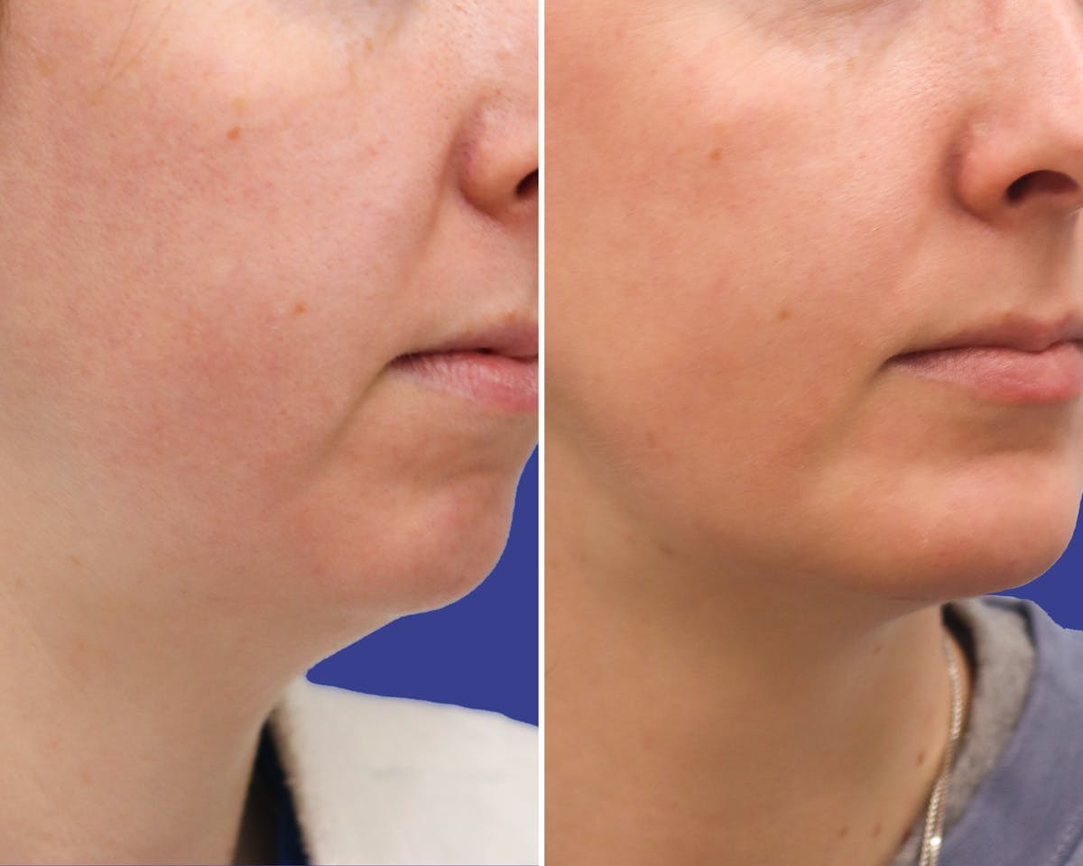 Neck Before & After Gallery - Patient 216636 - Image 2