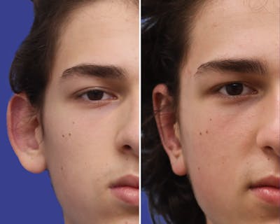 Otoplasty Before & After Gallery - Patient 378244 - Image 1