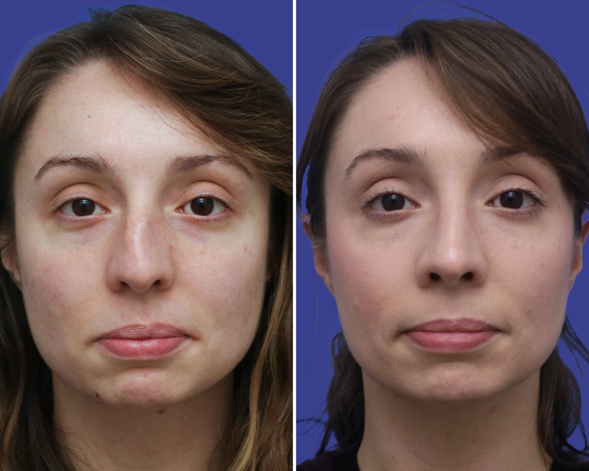 Rhinoplasty Before & After Gallery - Patient 367515 - Image 3