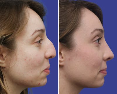 Rhinoplasty Before & After Gallery - Patient 367515 - Image 1
