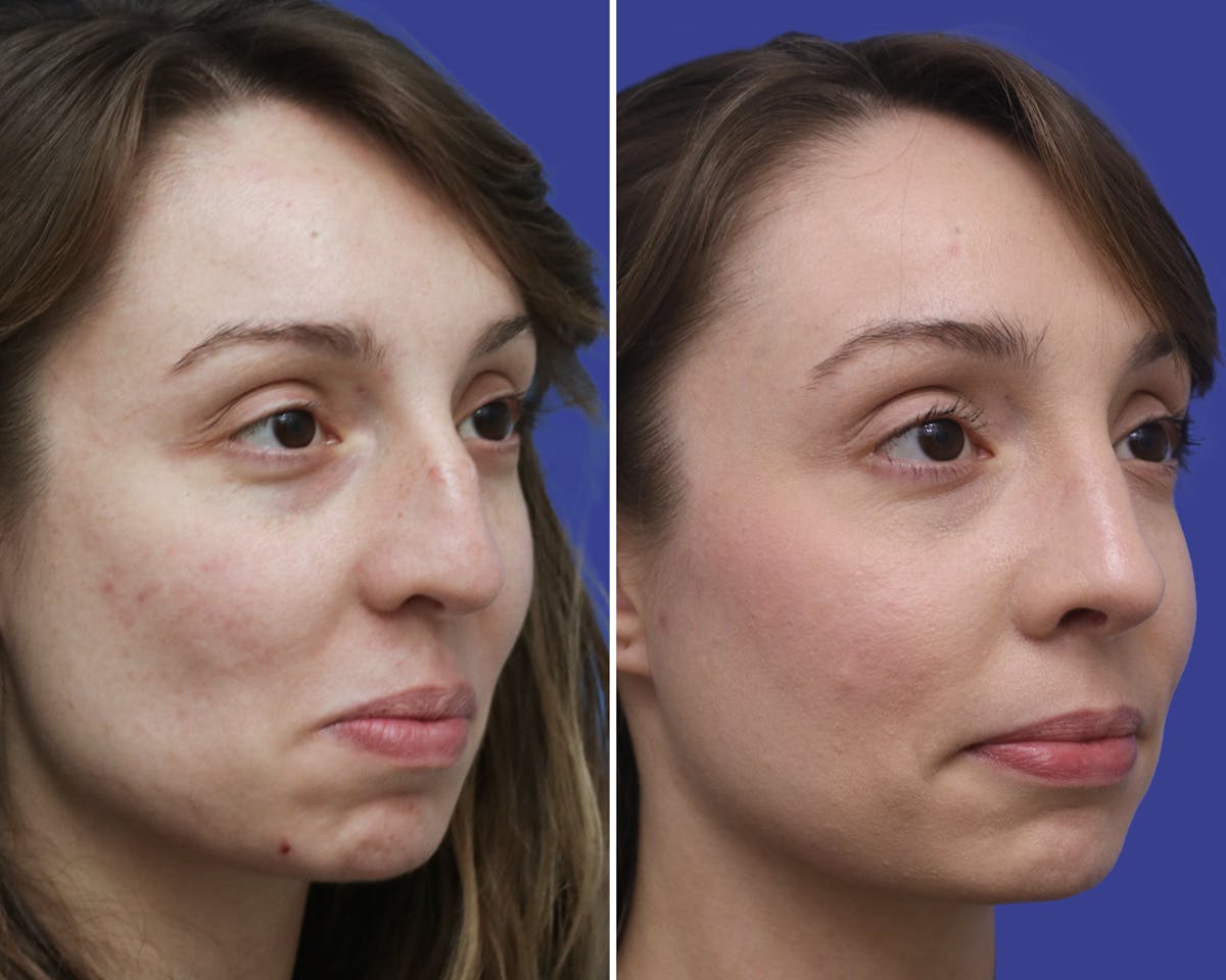 Rhinoplasty Before & After Gallery - Patient 367515 - Image 2