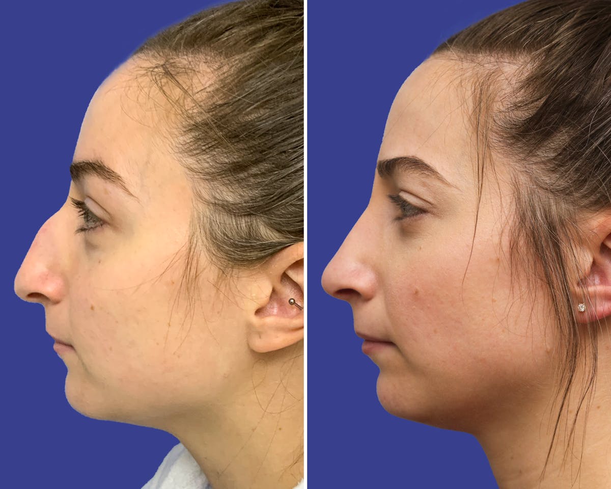 Rhinoplasty Before & After Gallery - Patient 263360 - Image 1
