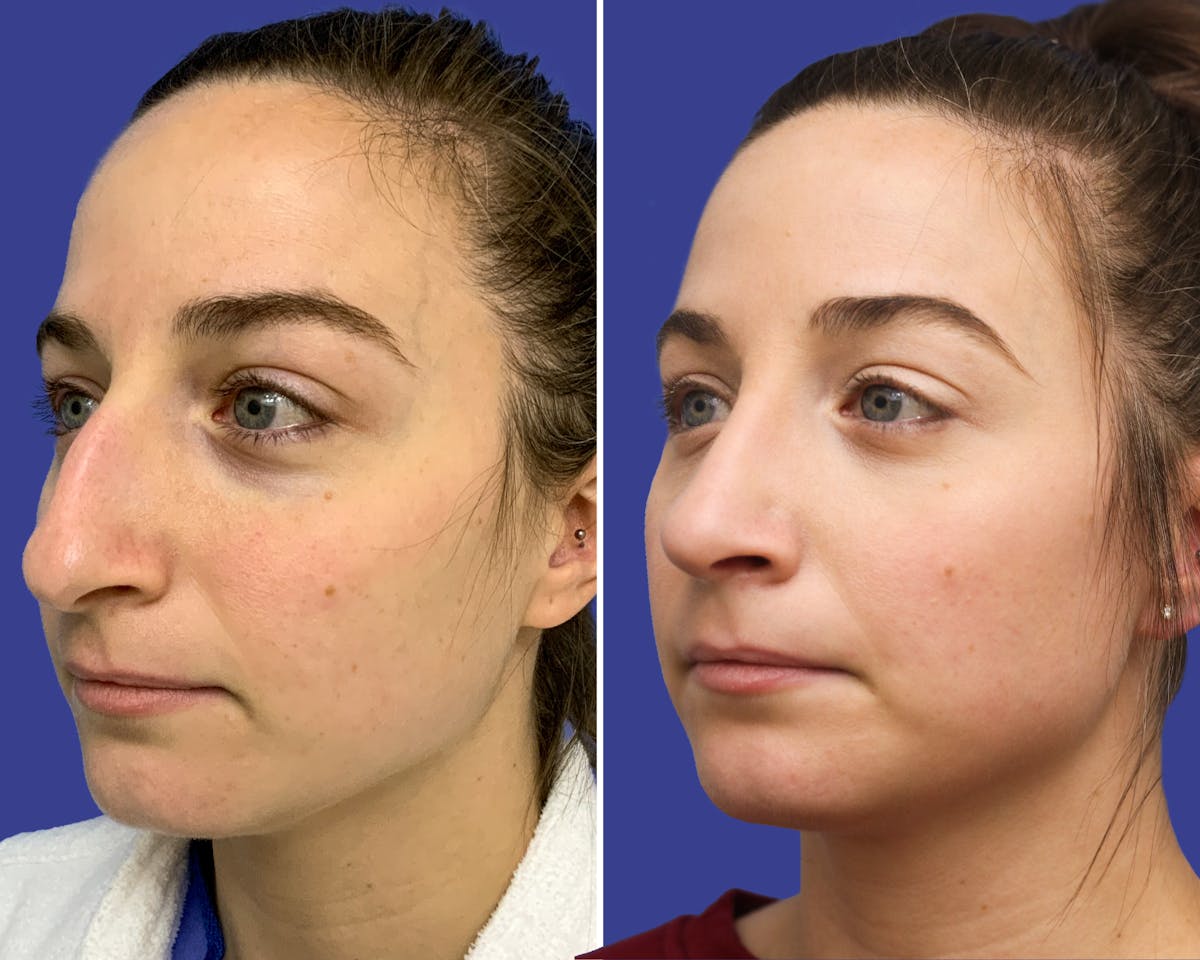 Rhinoplasty Before & After Gallery - Patient 263360 - Image 2