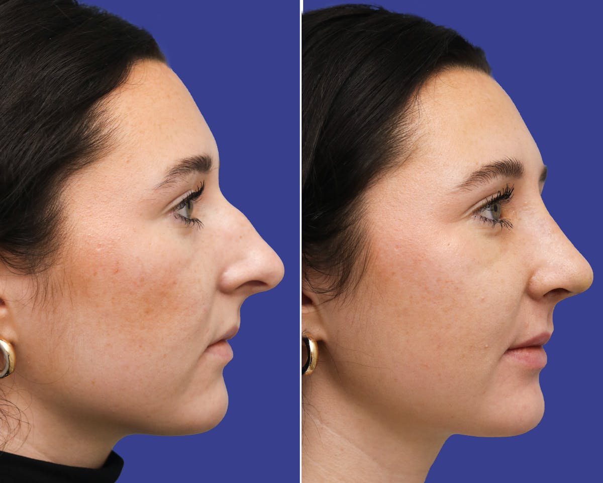 Rhinoplasty Before & After Gallery - Patient 215131 - Image 2