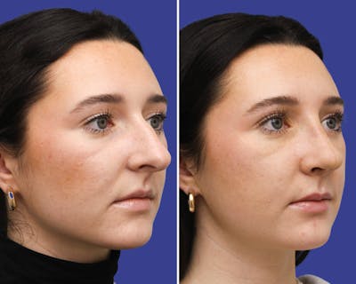 Rhinoplasty Before & After Gallery - Patient 215131 - Image 1