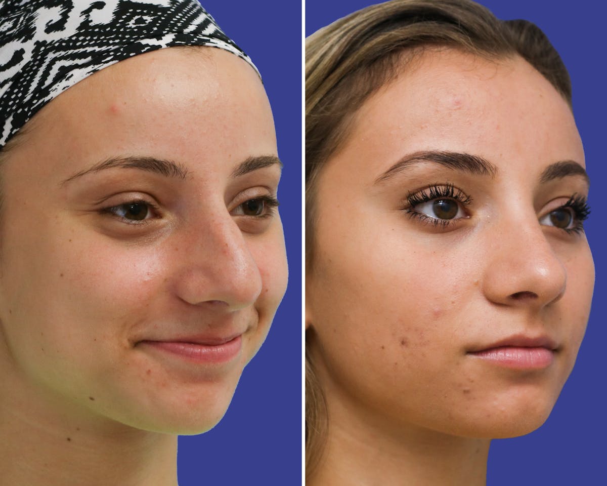 Rhinoplasty Before & After Gallery - Patient 550796 - Image 1