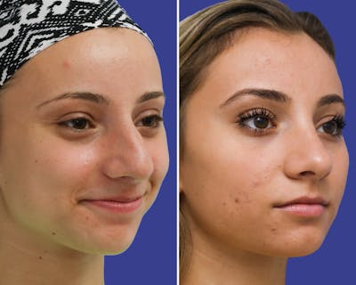 Rhinoplasty Before & After Gallery - Patient 550796 - Image 1
