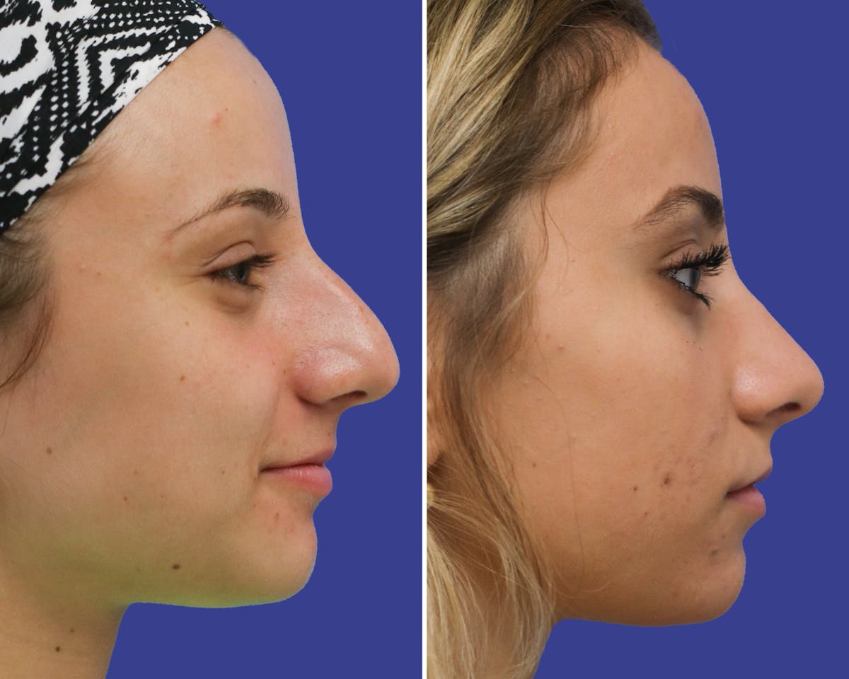 Rhinoplasty Before & After Gallery - Patient 550796 - Image 2