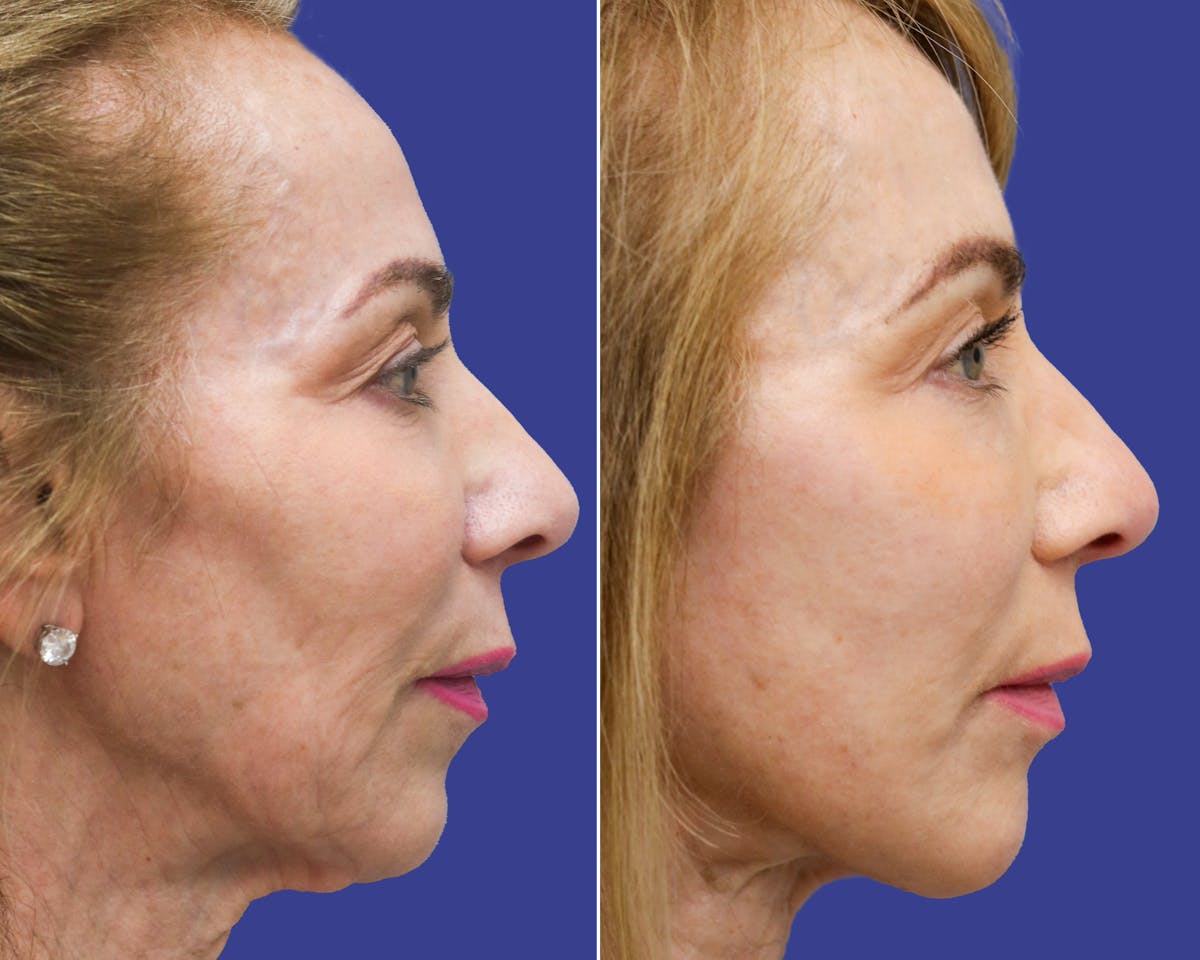 Temple Lift Before & After Gallery - Patient 163869 - Image 2
