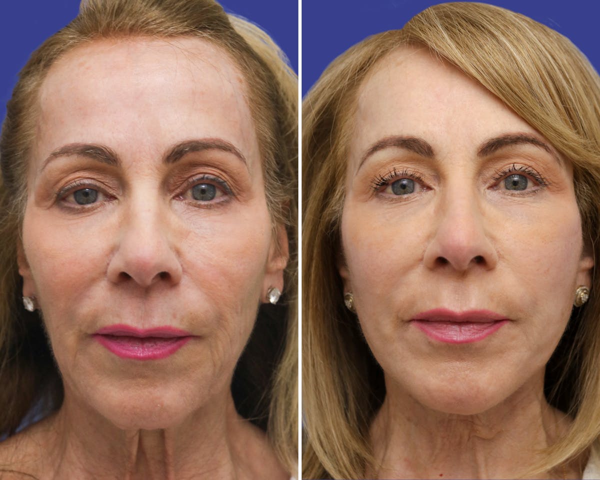Temple Lift Before & After Gallery - Patient 163869 - Image 1