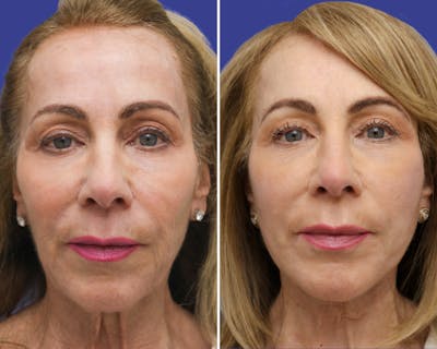 Temple Lift Before & After Gallery - Patient 163869 - Image 1