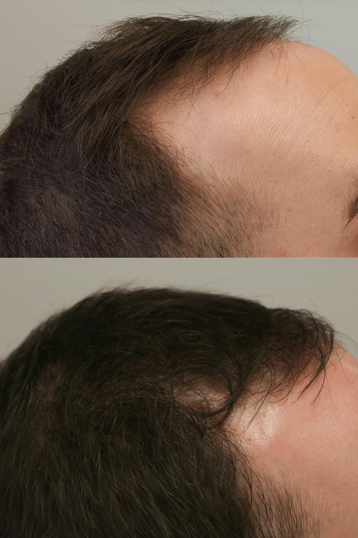 PRP Hair Restoration Before & After Gallery - Patient 132565 - Image 3