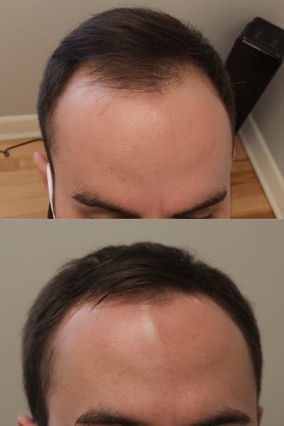 PRP Hair Restoration Before & After Gallery - Patient 132565 - Image 1