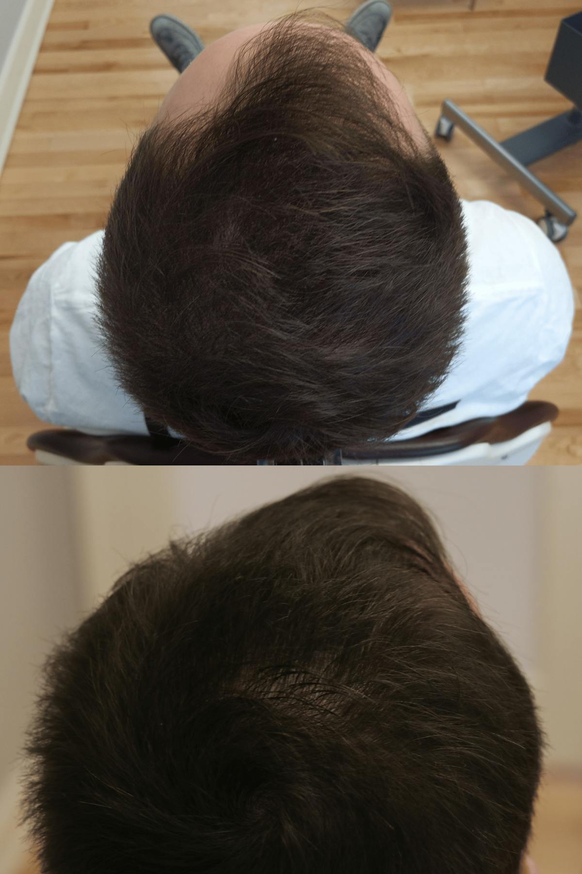PRP Hair Restoration Before & After Gallery - Patient 132565 - Image 4