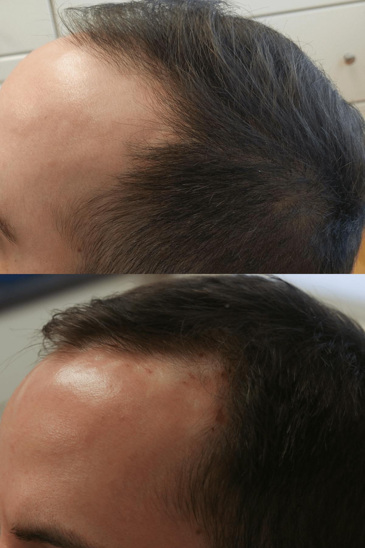 PRP Hair Restoration Before & After Gallery - Patient 132565 - Image 2