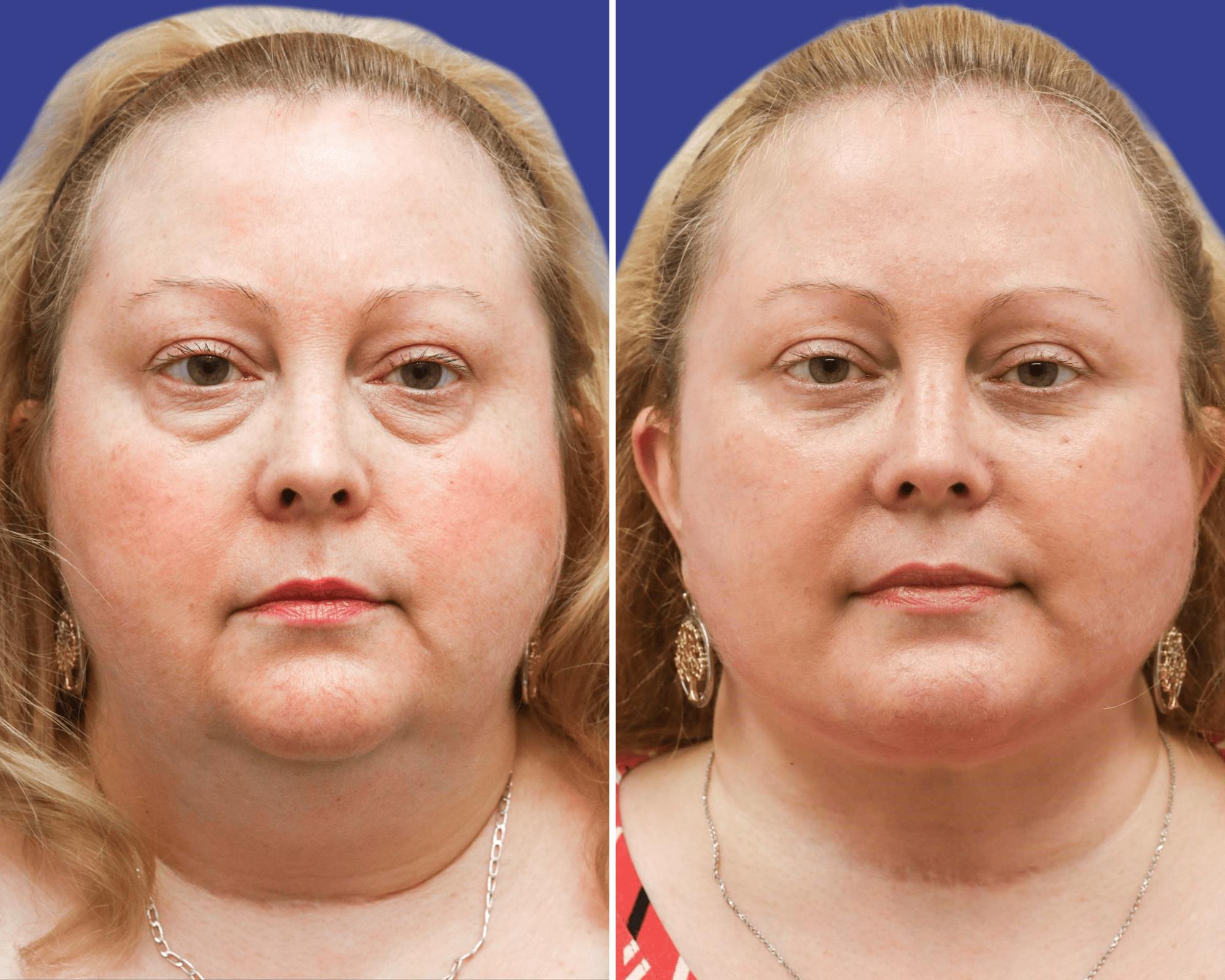 Face Before & After Gallery - Patient 373801 - Image 1