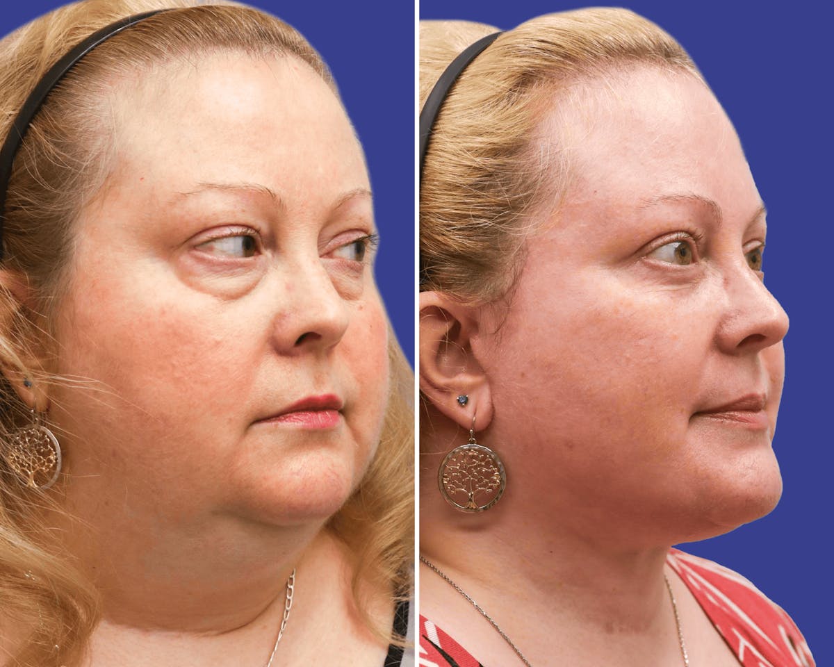 Facelift Before & After Gallery - Patient 380489 - Image 2