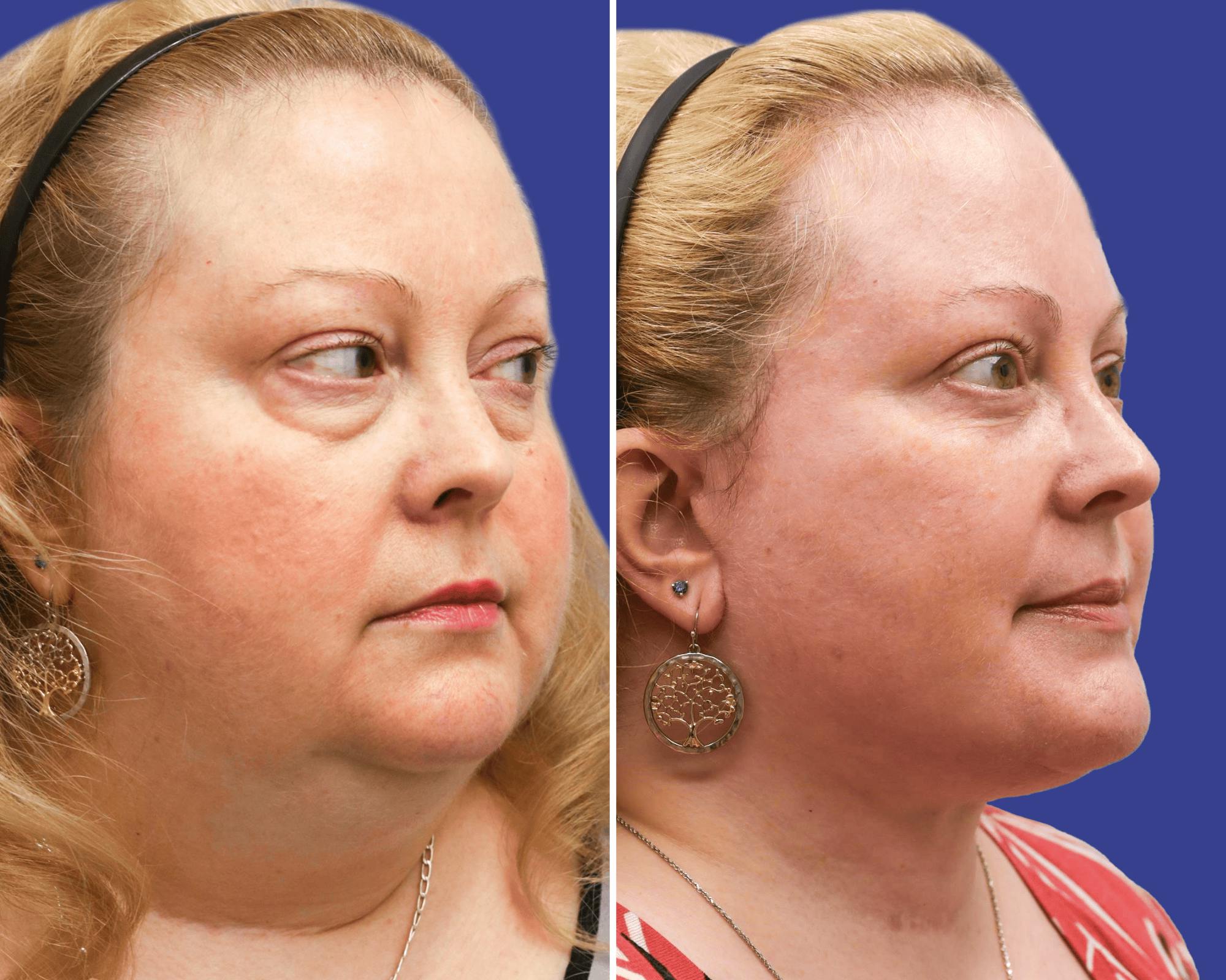 Face Before & After Gallery - Patient 373801 - Image 2
