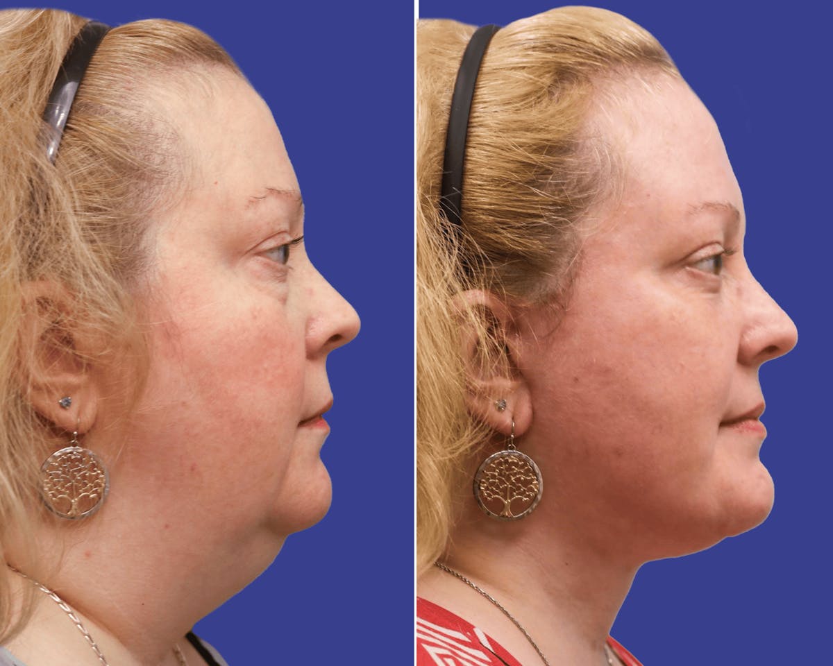 Facelift Before & After Gallery - Patient 380489 - Image 3