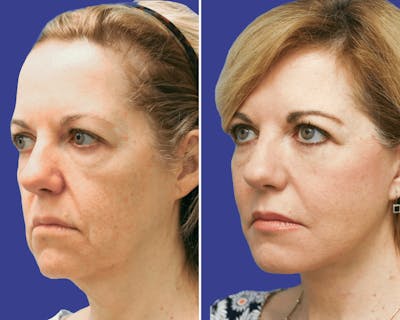 Face Before & After Gallery - Patient 378527 - Image 1