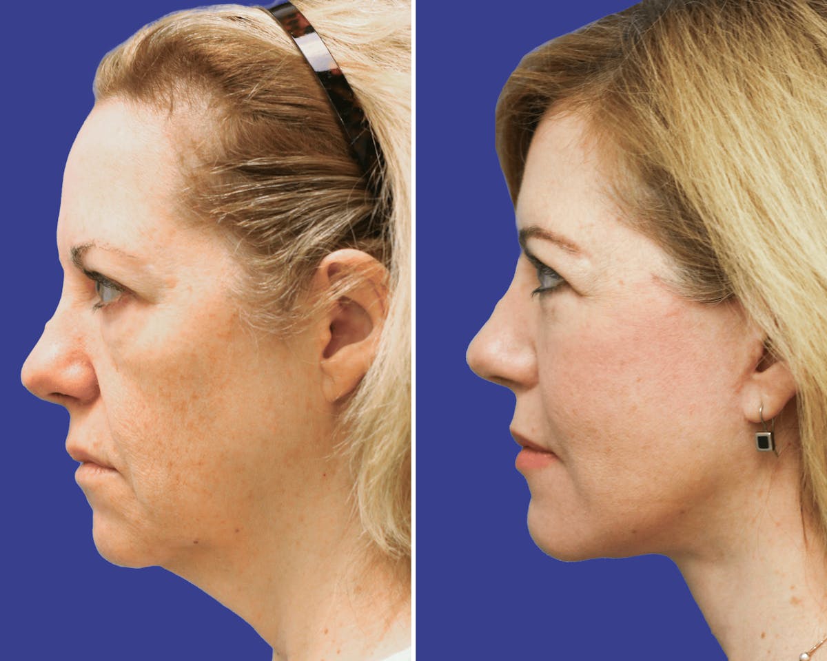 Face Before & After Gallery - Patient 378527 - Image 2