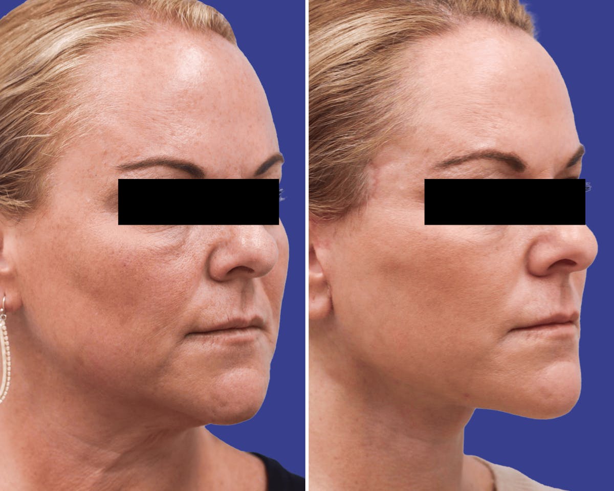 Facelift Before & After Gallery - Patient 363270 - Image 1