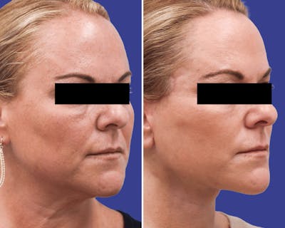 Face Before & After Gallery - Patient 388509 - Image 1