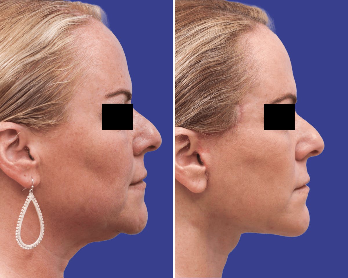 Facelift Before & After Gallery - Patient 363270 - Image 2