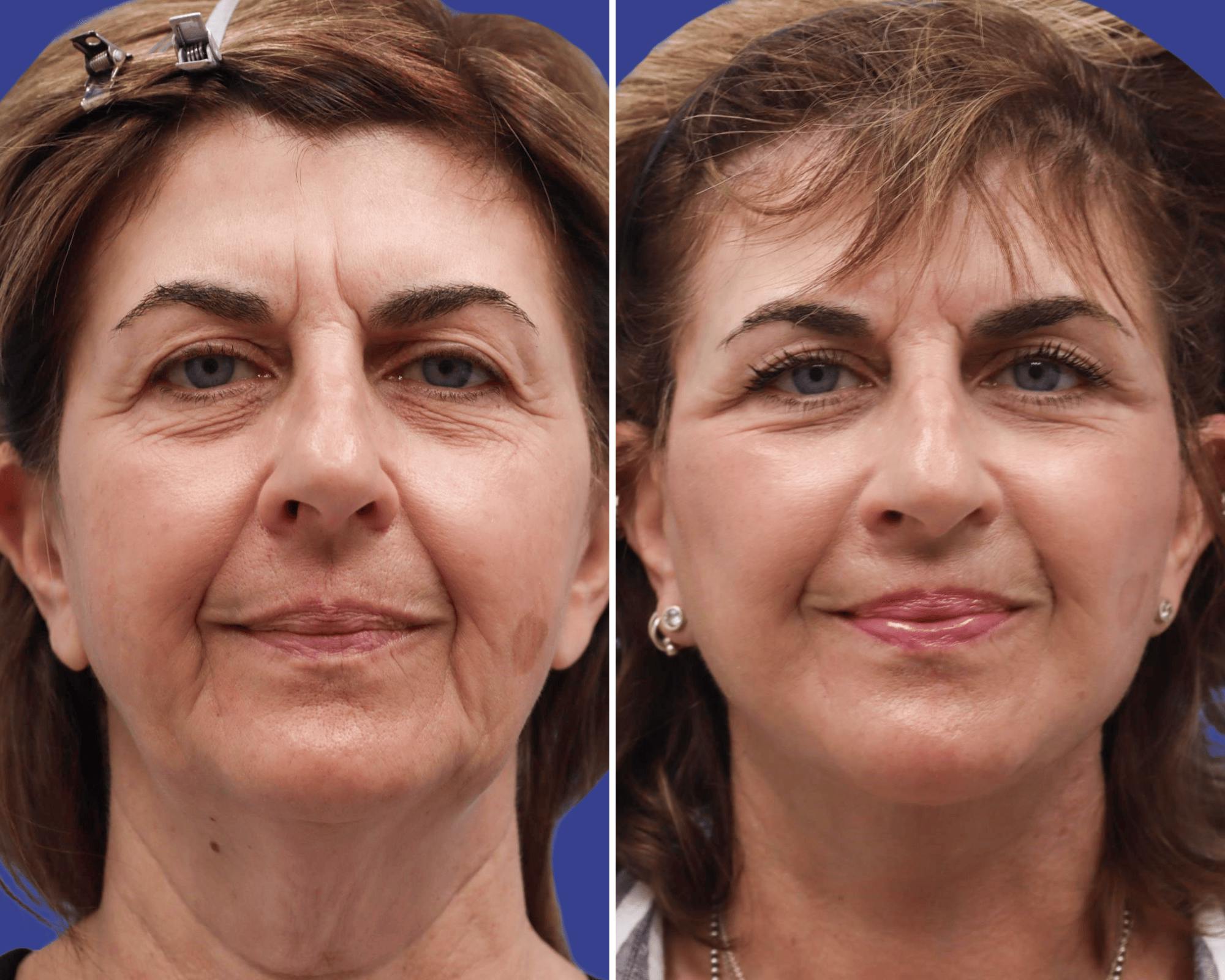 Face Before & After Gallery - Patient 327048 - Image 1