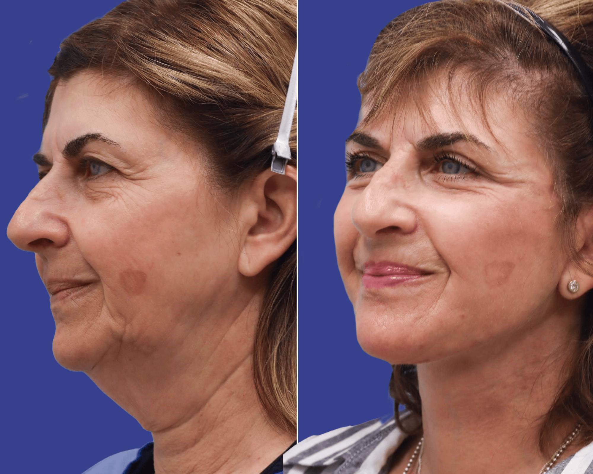 Face Before & After Gallery - Patient 327048 - Image 2