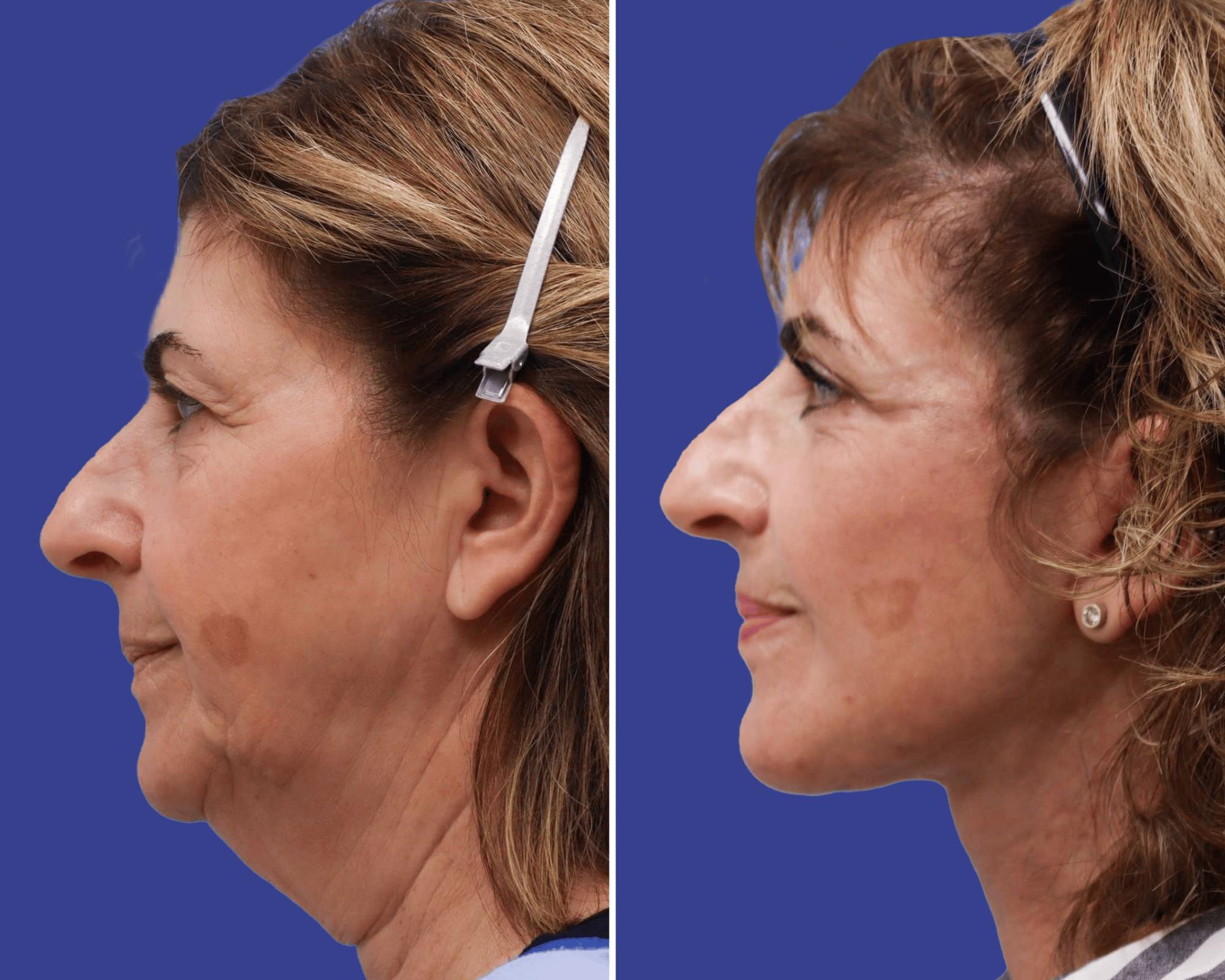 Face Before & After Gallery - Patient 327048 - Image 3