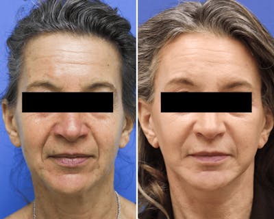 Face Before & After Gallery - Patient 161885 - Image 1