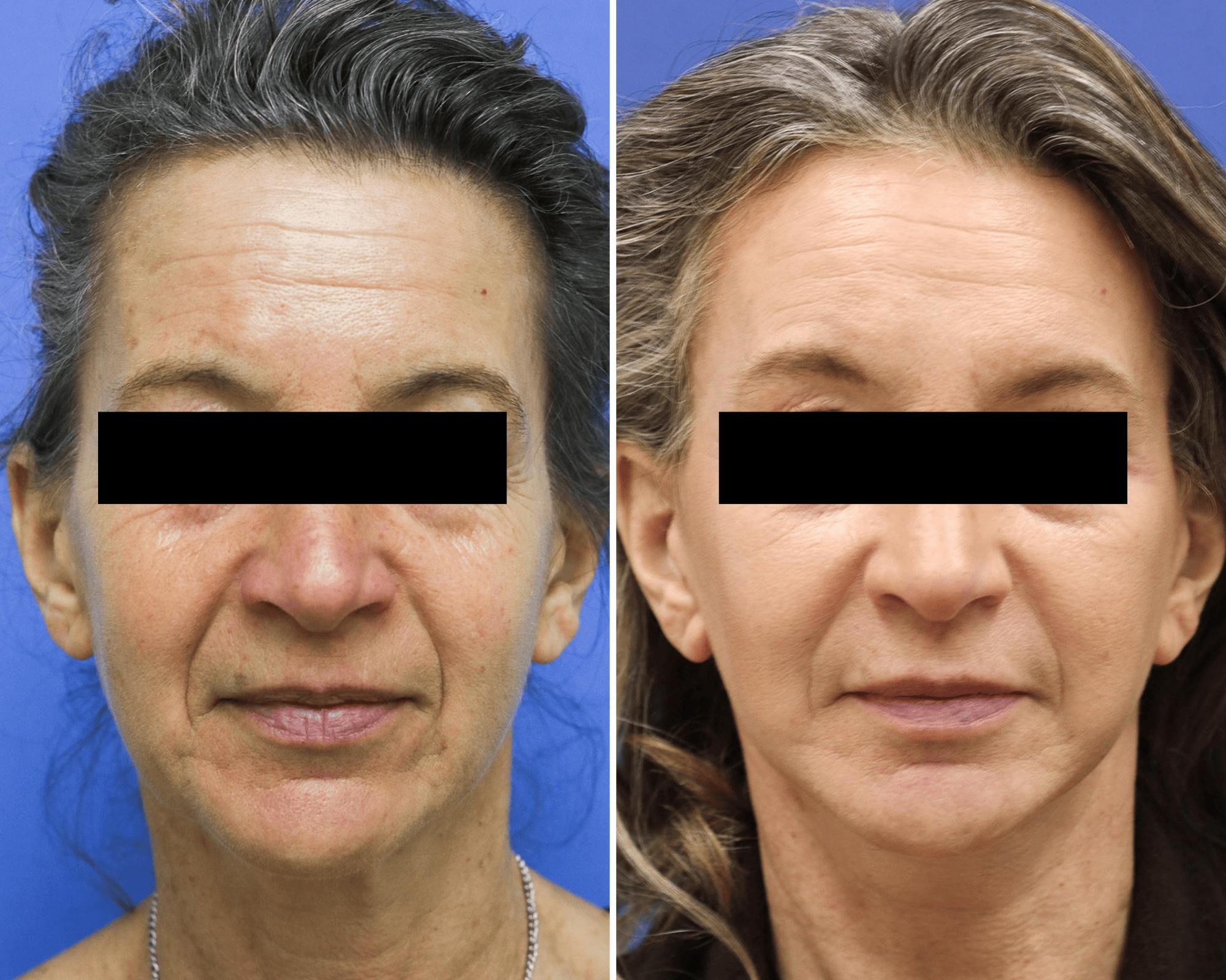 Buccal Fat Removal Before & After Gallery - Patient 422850 - Image 1