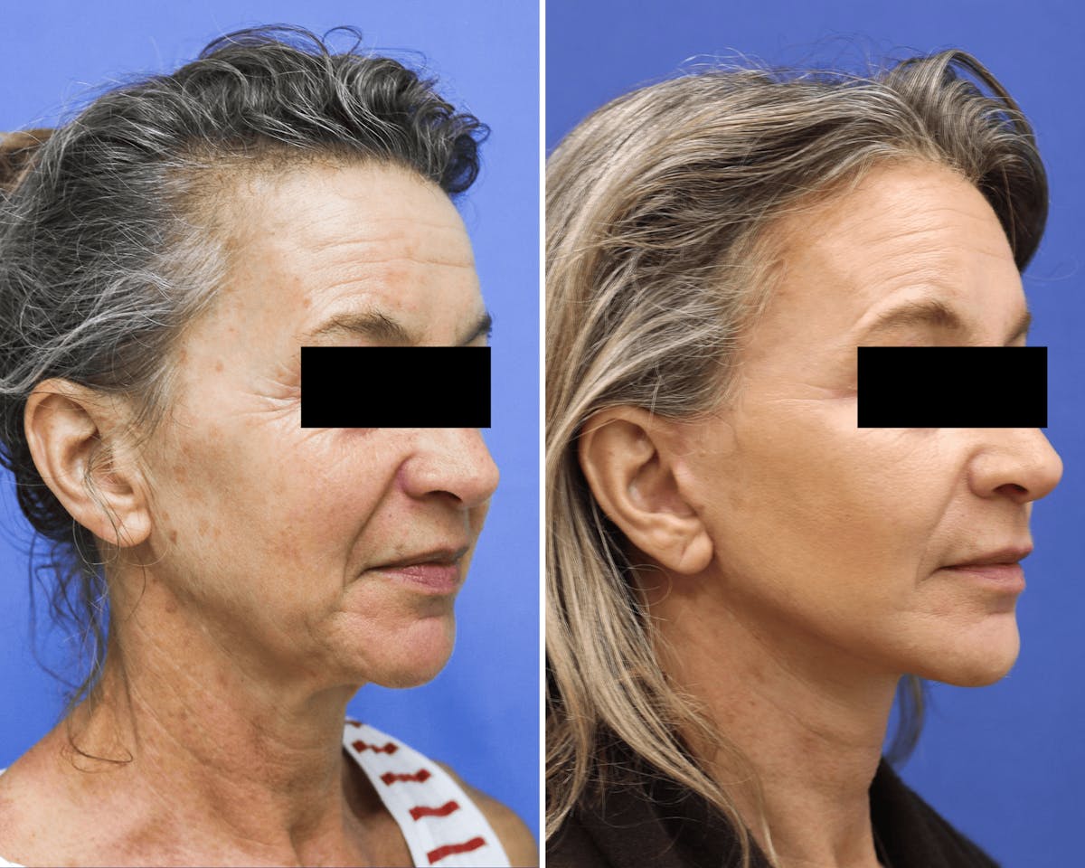 Facelift Before & After Gallery - Patient 112295 - Image 2