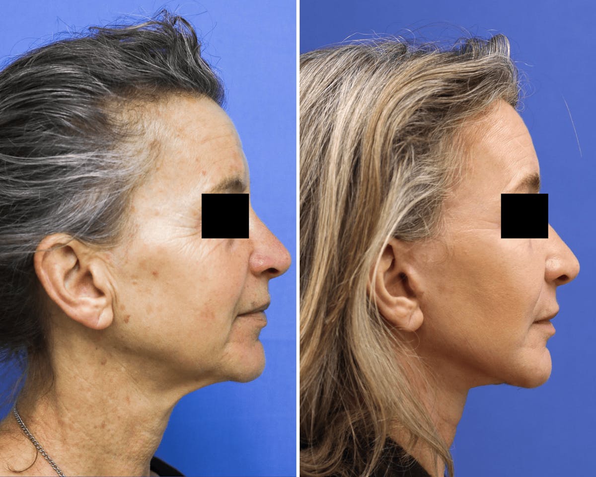 Facelift Before & After Gallery - Patient 112295 - Image 3