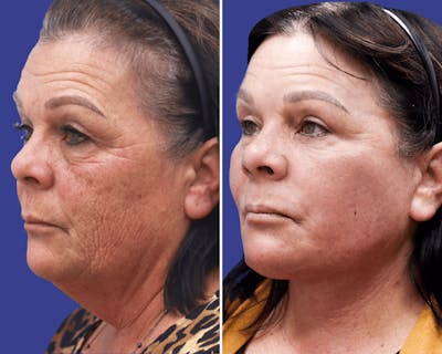 CO2 Laser Resurfacing Before & After Gallery - Patient 410591 - Image 1