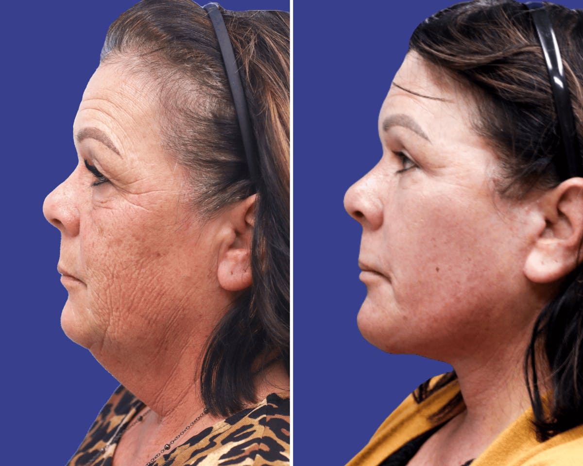 Face Before & After Gallery - Patient 285981 - Image 2