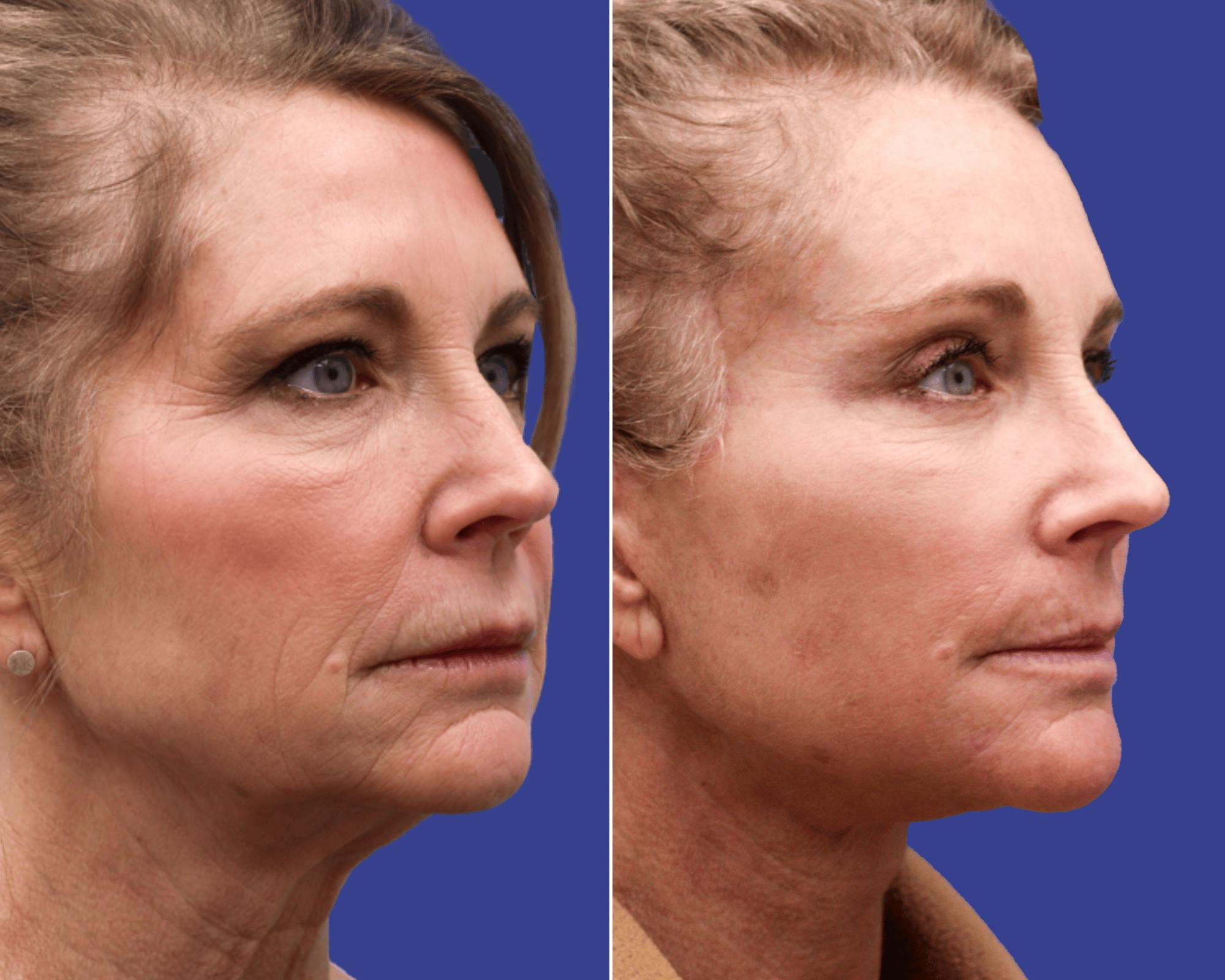 Face Before & After Gallery - Patient 984906 - Image 1