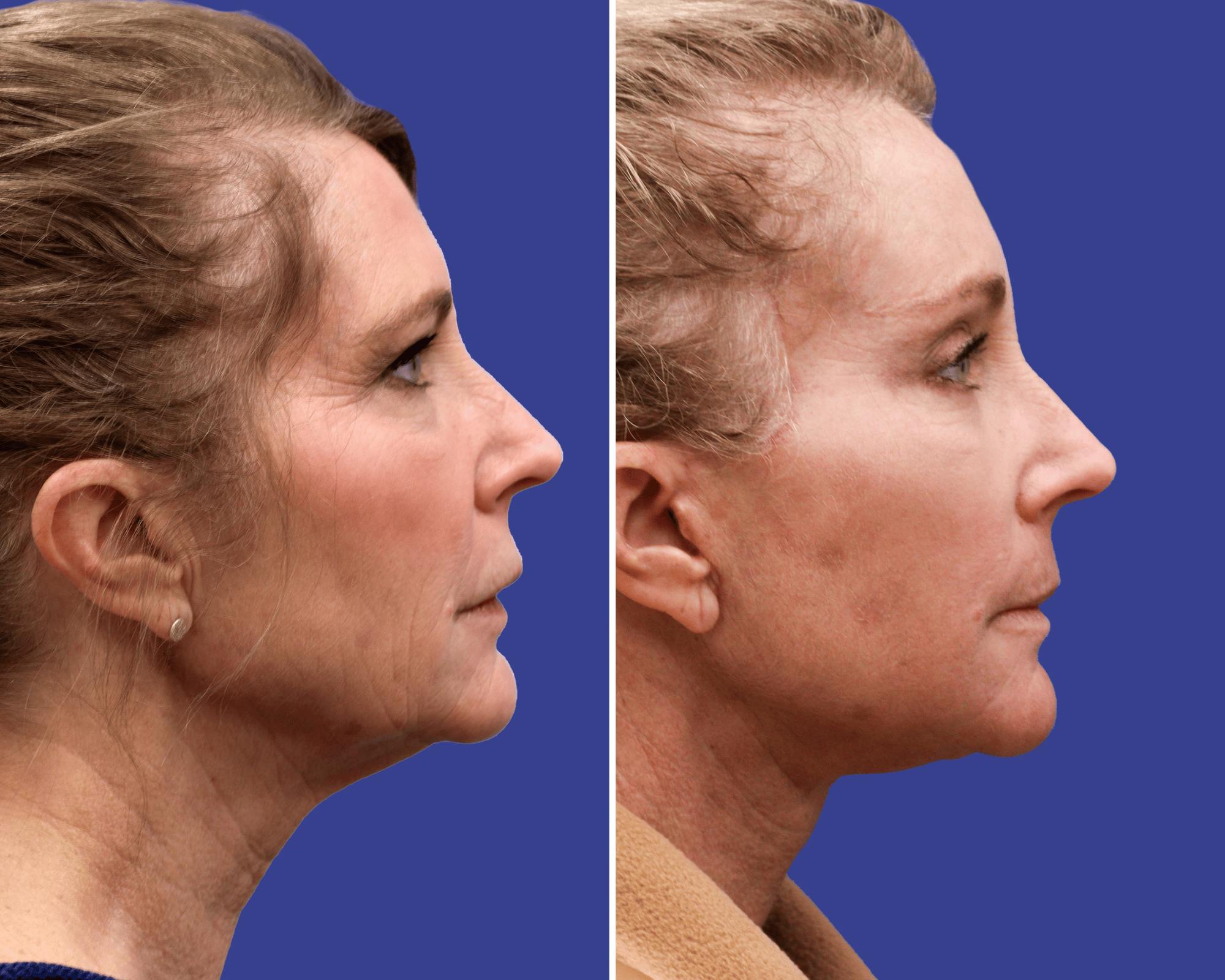 Face Before & After Gallery - Patient 984906 - Image 2