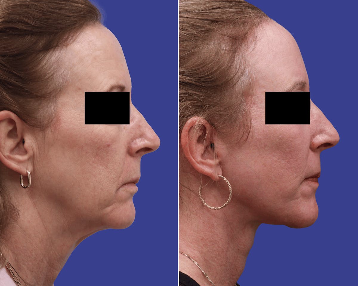 Facelift Before & After Gallery - Patient 896976 - Image 1
