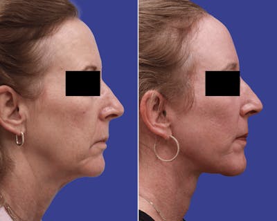Face Before & After Gallery - Patient 316451 - Image 1