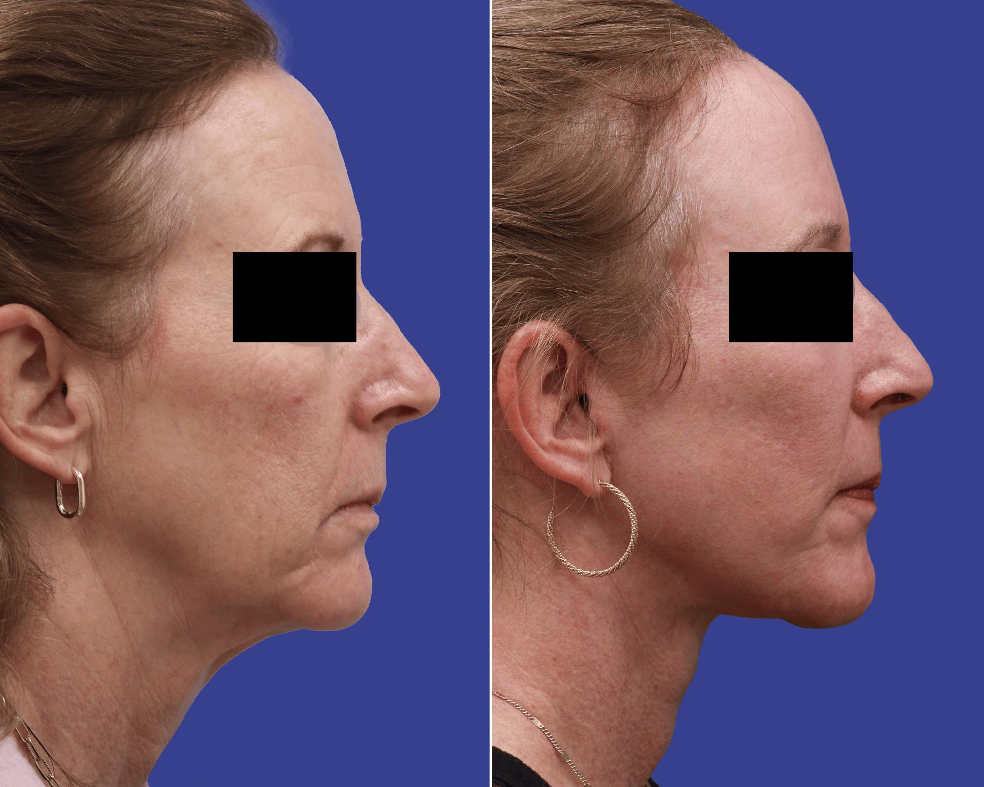 CO2 Laser Resurfacing Before & After Gallery - Patient 173849 - Image 2