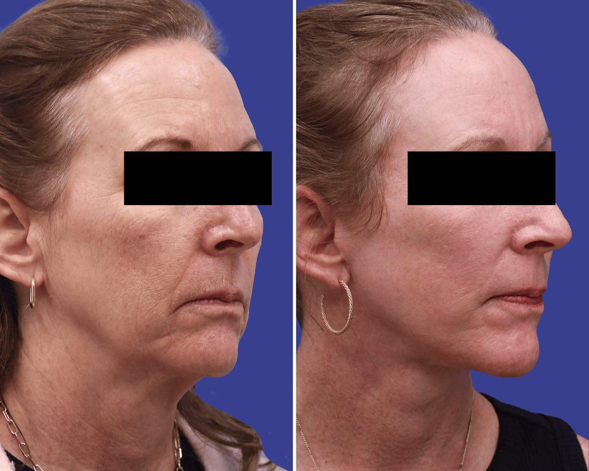 Facelift Before & After Gallery - Patient 896976 - Image 2