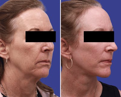 Neck Before & After Gallery - Patient 411329 - Image 1