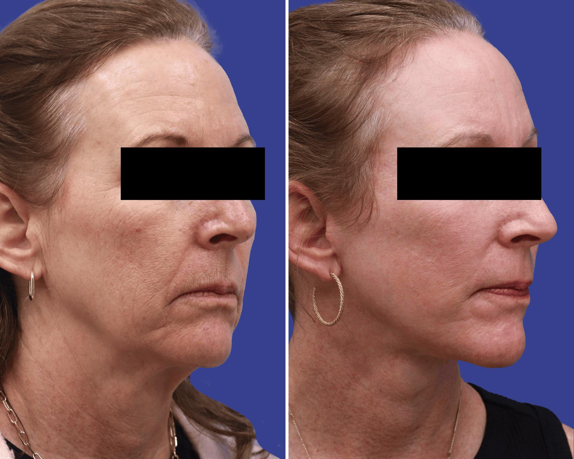 CO2 Laser Resurfacing Before & After Gallery - Patient 173849 - Image 1