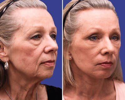 Face Before & After Gallery - Patient 312269 - Image 1
