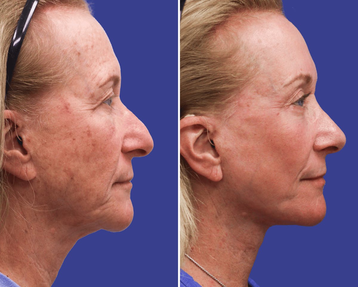 Face Before & After Gallery - Patient 411084 - Image 3