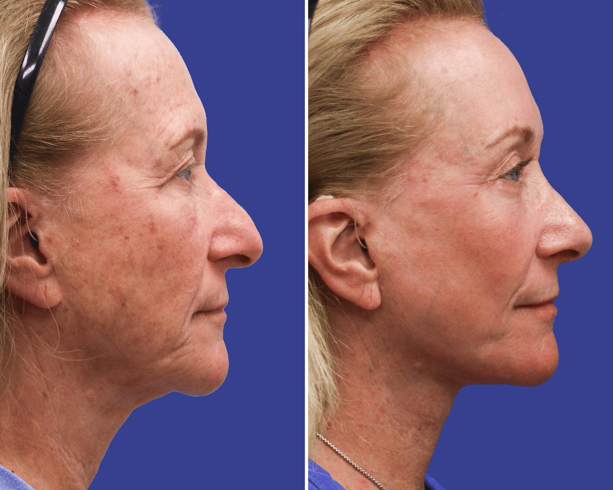 Blepharoplasty Before & After Gallery - Patient 263425 - Image 3
